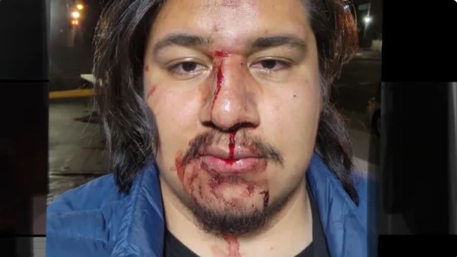 Erick Flores was left bloodied and with a broken nose after being beaten and robbed by two men on May 2, 2024 in Long Beach. (GoFundMe)