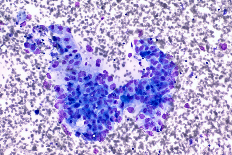 <span class="caption">Photomicrograph of CT (CAT) scan-guided fine needle aspirate (FNA) cytology of a pancreatic mass showing malignant cells indicating adenocarcinoma.</span> <span class="attribution"><a class="link " href="https://www.shutterstock.com/download/success" rel="nofollow noopener" target="_blank" data-ylk="slk:Shutterstock;elm:context_link;itc:0;sec:content-canvas">Shutterstock</a></span>