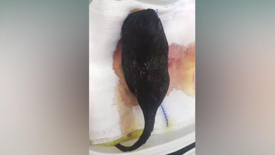 A 250 gram hairball has been discovered in a 12-year-old girl’s stomach. Source: AsiaWire/ Australscope