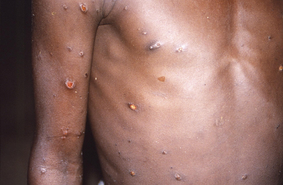 This 1997 image provided by CDC, shows the right arm and torso of a patient, whose skin displayed a number of lesions due to what had been an active case of monkeypox. As more cases of monkeypox are detected in Europe and North America in 2022, some scientists who have monitored numerous outbreaks in Africa say they are baffled by the unusual disease's spread in developed countries. (CDC via AP)