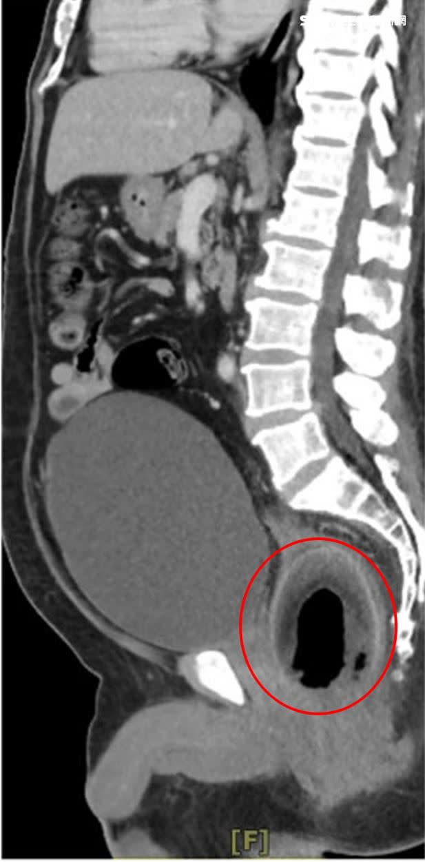 電腦斷層檢查影像中，可看到男子直腸內有一顆椰子。（圖／陳致一提供）