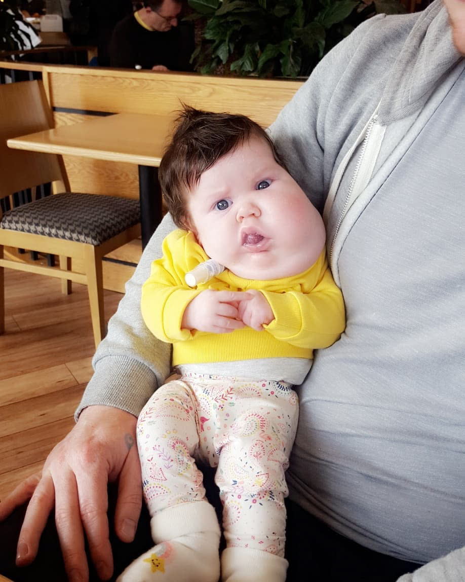 Evie Delaney in a yellow jumper. She has cystic hygroma.