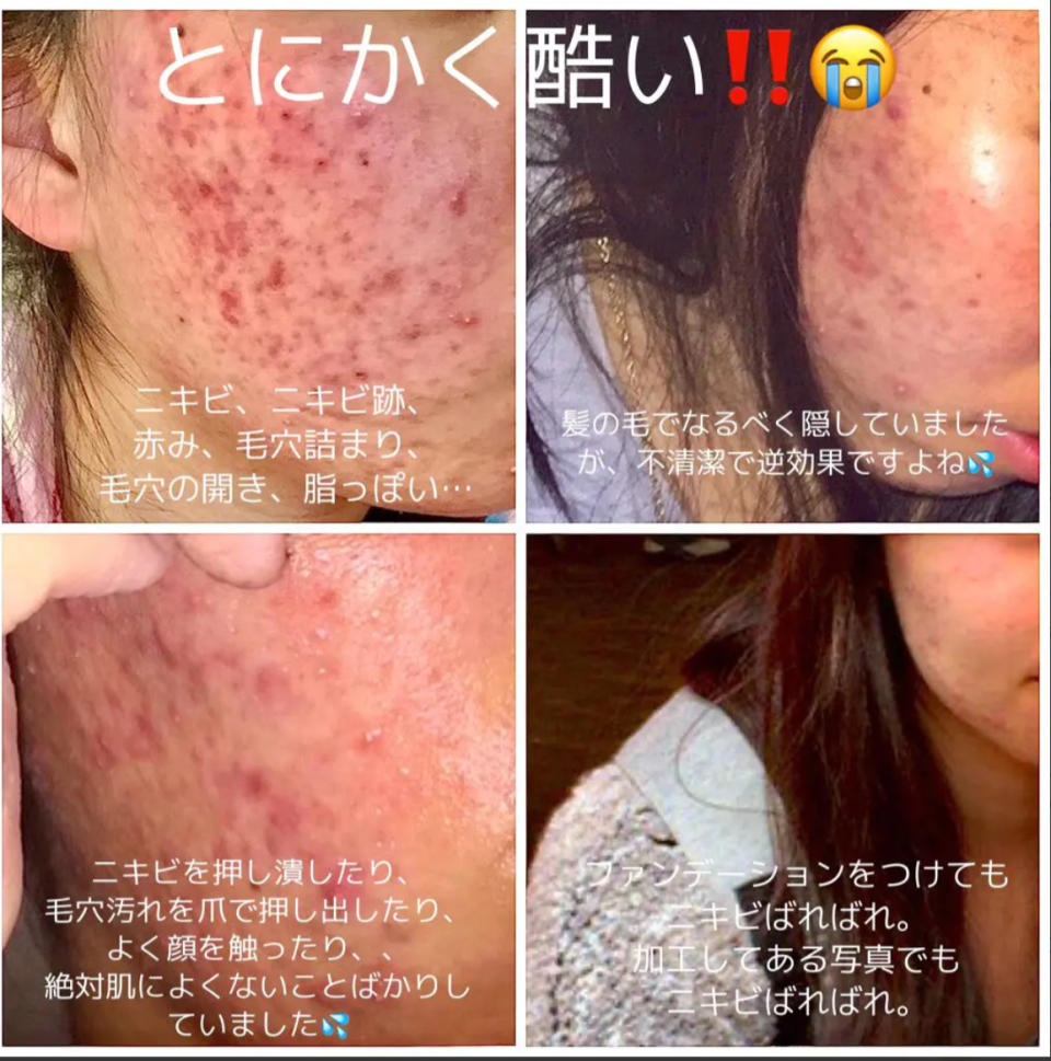 暗瘡肌膚可以用咩護膚品？日本女生花1年時間靠3款開架暗瘡肌膚護膚品回復白滑肌