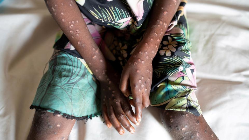 Young girl with monkeypox lesions on her arms and legs