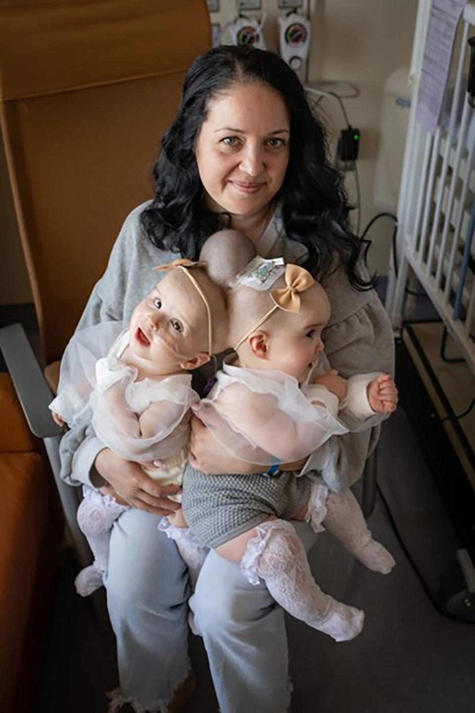 9-Month-Old Twins Conjoined at the Head Are Successfully Separated: 'A Very, Very Rare Anomaly'