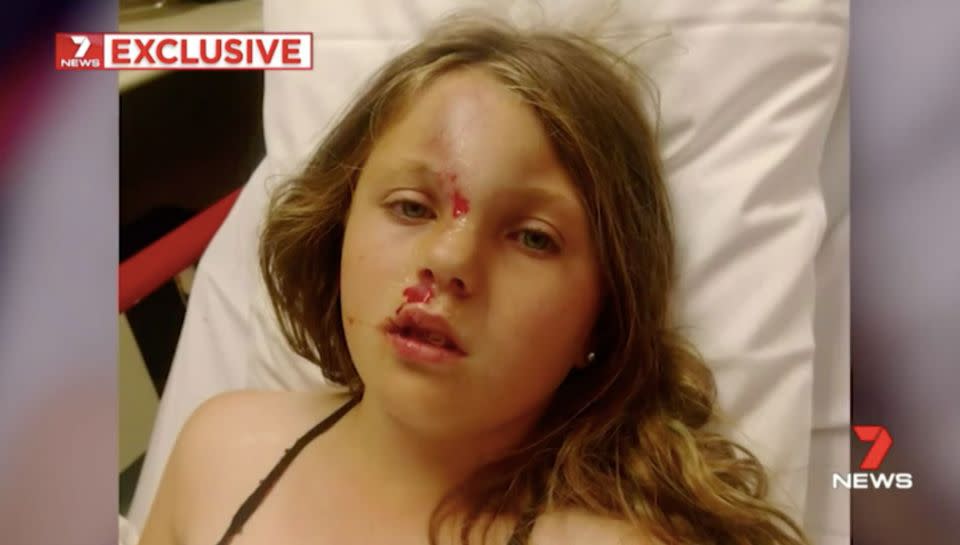 Alannah had facial injuries and skull fractures. Source: 7 News