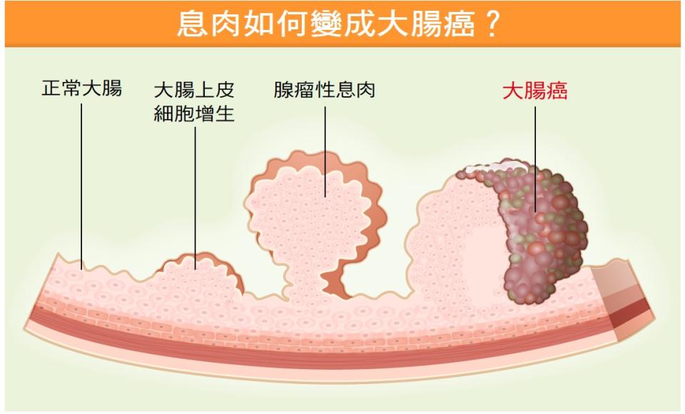 息肉如何變成大腸癌？