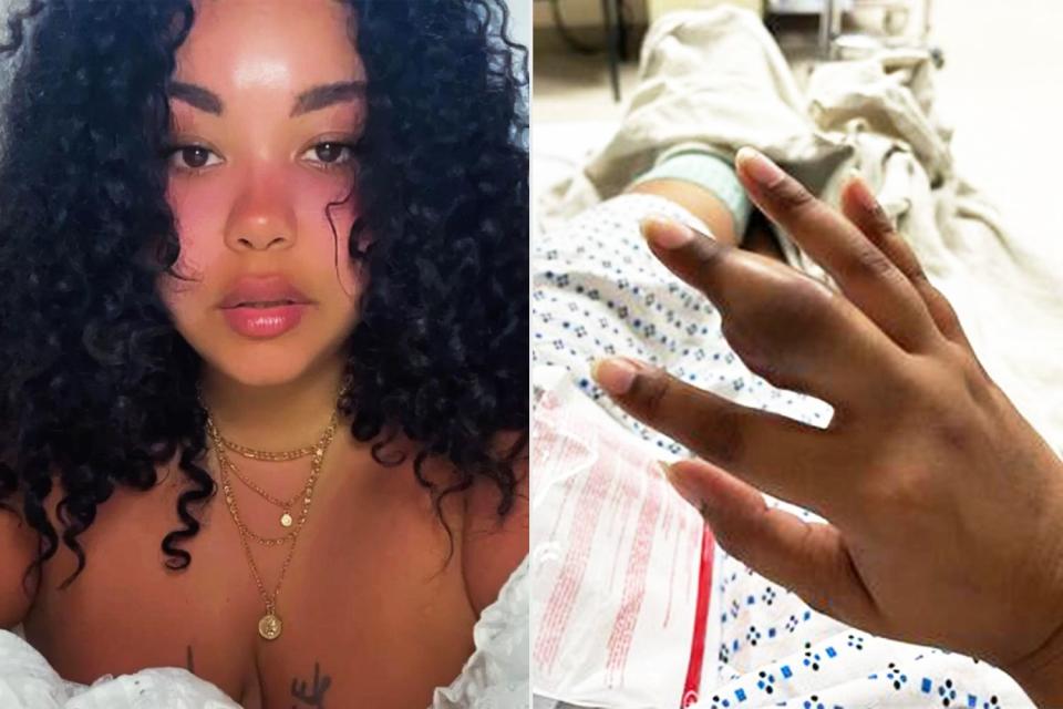 <p>Natalie Garcia</p> Natalie Garcia shows off tumor in finger. 