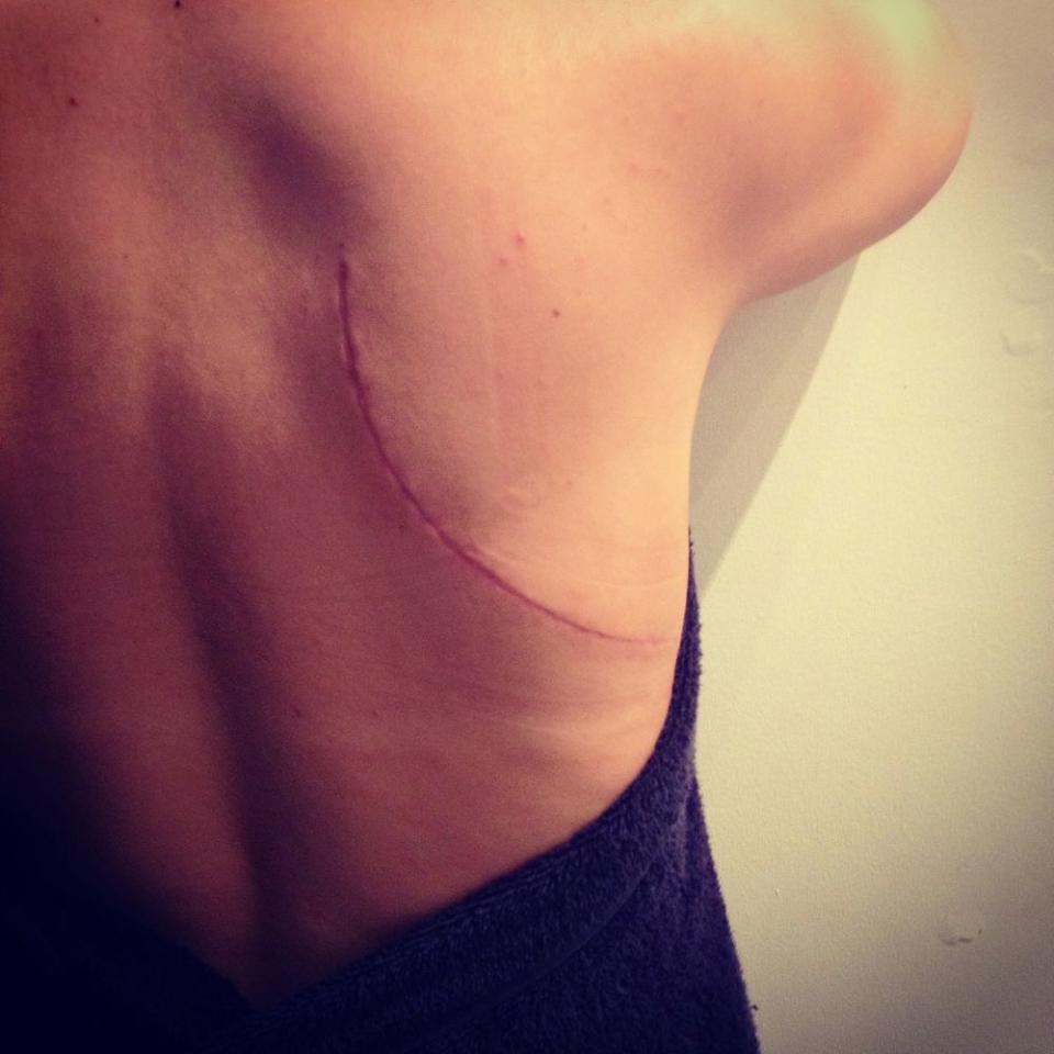 Amanda Kouri post-surgical scar | Courtesy Amanda Kouri