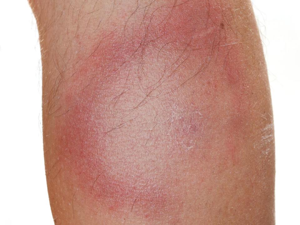 Circular red rash on someone's leg, the redness subsides in the center.