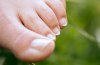 10. Red flag: Pitted toenails. What it means: In up to half of all people with psoriasis, the skin disease also shows up in the nail as many little holes, which can be deep or shallow. More than three-fourths of those with psoriatic arthritis, a related disorder that affects the joints as well as the skin, also have pocked, pitted nails. More clues: The nails (fingers as well as toes) will also thicken. They may be yellow-brown or have salmon-colored patches. The knuckle nearest the nail is also likely to be dry, red, and inflamed. What to do: A variety of medications can treat both psoriasis and psoriatic arthritis and can restore the nail bed surface in many cases, especially if treatment begins early.