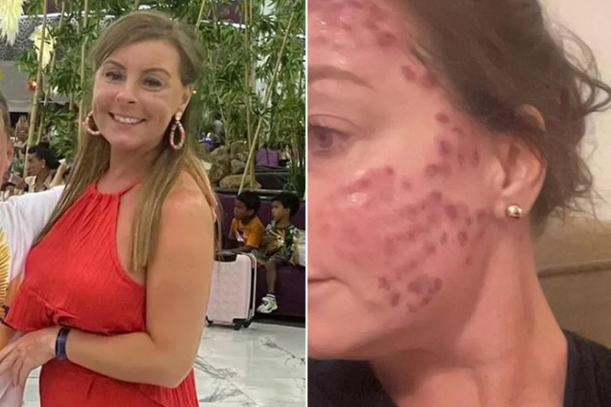 A woman obsessed with tanning feels lucky to be alive after discovering two cancerous moles — and she's using her harrowing experience to share the risks of indoor tanning.