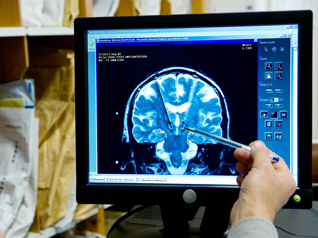 MRI of a 30-year-old patient suffering from dystonia.