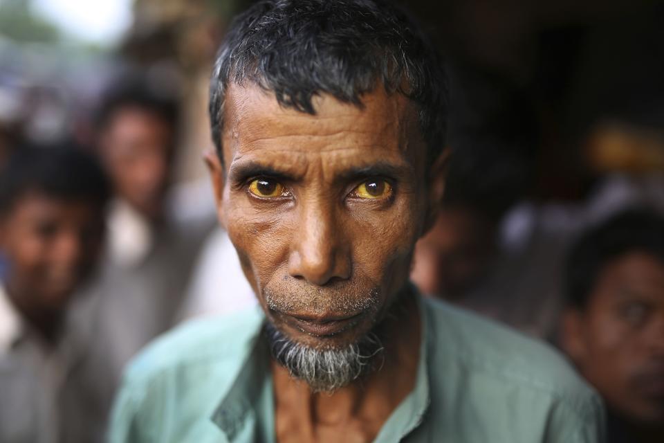 In this photograph taken Aug. 24, 2018, a Rohingya man suffering from jaundice is seen in Kutupalong refugee camp, Bangladesh. Faith healers have long been sought out in Rohingya society to treat physical and mental ailments. Their trade has thrived in part because of traditional beliefs and in part because Rohingya have lacked access to modern medical care in Buddhist-majority Myanmar, where they are one of the most persecuted minority groups in the world. Access to medical care has changed for the better in the refugee camps in Bangladesh, yet many Rohingya still seek out their faith healers. (AP Photo/Altaf Qadri)