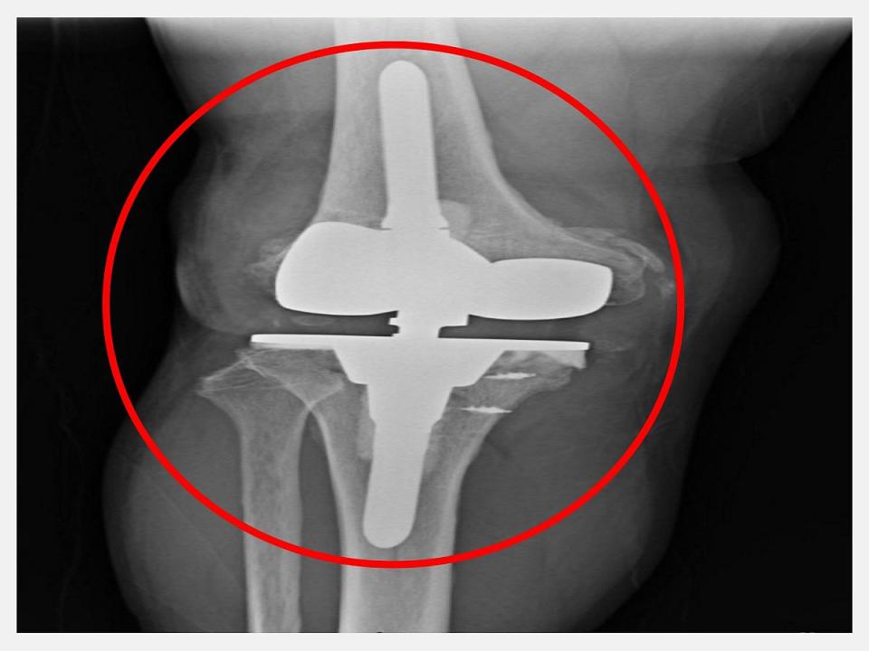 醫師說，使用新式的預鎖式樞紐設計的人工關節不僅取代韌帶的功能維持關節穩定，也可以填充骨頭的缺損。（圖：仁愛長庚合作聯盟醫院提供）
