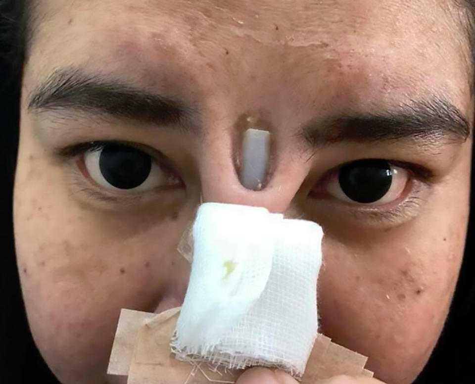 <em>Botched – the woman was left with a silicone implant sticking out between her eyes (Pictures: AsiaWire)</em>