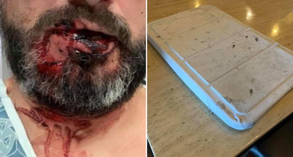 A photo of a man's injuries who claims he was hit in the face by an Esky lid, pictured on the right.