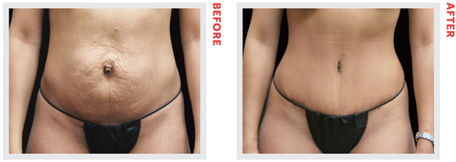 Plus-Size Tummy Tuck Houston & Sugar Land, TX