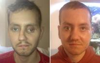 <p>A Wales man is thought to be one of the first to receive major 3D-printed plastic surgery, <a href="http://www.everwideningcircles.com/2014/04/19/3d-printing-our-world/" rel="nofollow noopener" target="_blank" data-ylk="slk:receiving a 3D-printed eyeball and facial-structure plates;elm:context_link;itc:0;sec:content-canvas" class="link ">receiving a 3D-printed eyeball and facial-structure plates</a> in 2012. <i>(Photo: Getty)</i></p>