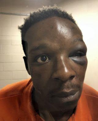 A September 12, 2020, photo provided by The Cochran Firm representing Roderick Walker shows him at Clayton County Jail in Jonesboro, Georgia, with a visible injury to his left eye. / Credit: Handout via Roderick Walker's Lawyers