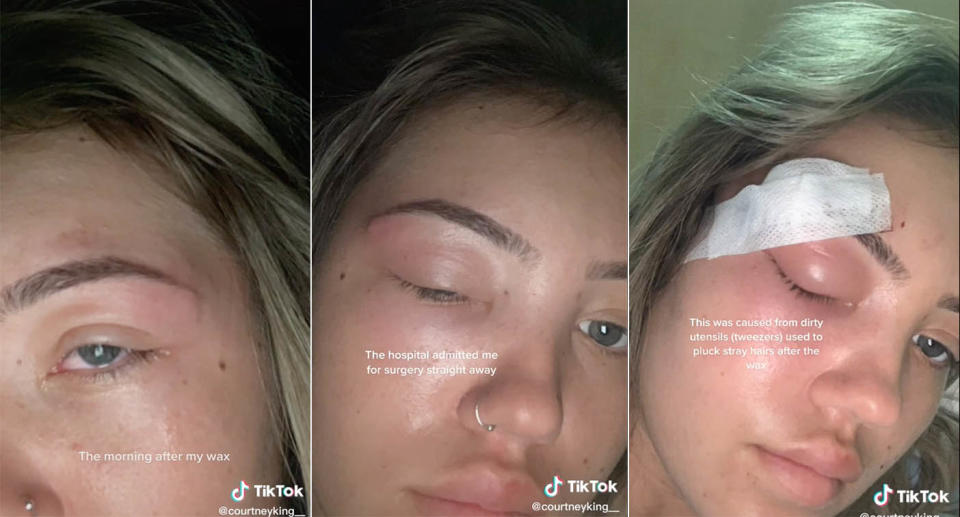 The woman contracted an infection after an eyebrow wax. Source: TikTok