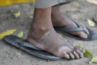 In this Monday, March 30, 2020, file photo, an injured foot of a daily wage laborer is seen as he rests on way to his village following a lockdown amid concern over spread of coronavirus on the outskirts of Prayagraj, India. Over the past week, India’s migrant workers - the mainstay of the country’s labor force - spilled out of big cities that have been shuttered due to the coronavirus and returned to their villages, sparking fears that the virus could spread to the countryside. It was an exodus unlike anything seen in India since the 1947 Partition, when British colothe subcontinent, with the 21-day lockdown leaving millions of migrants with no choice but to return to their home villages. (AP Photo/Rajesh Kumar Singh, File)