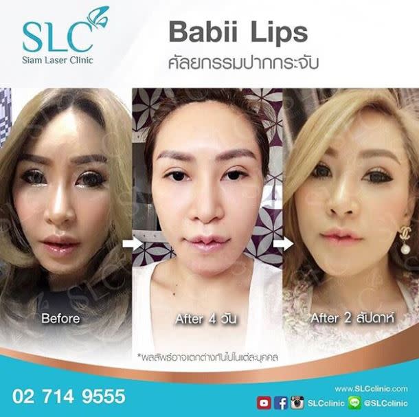 Thailändische Kliniken werben mit den “krachap lips” – und verdienen damit ein Heidengeld. Foto: Instagram (secclinic)