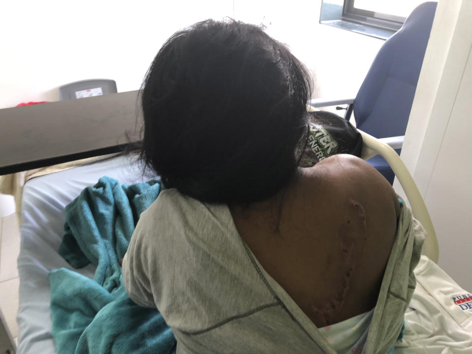 The injuries of Panama cult survivor Dina Blanco. Seven people were killed in the remote village of El Terrón.