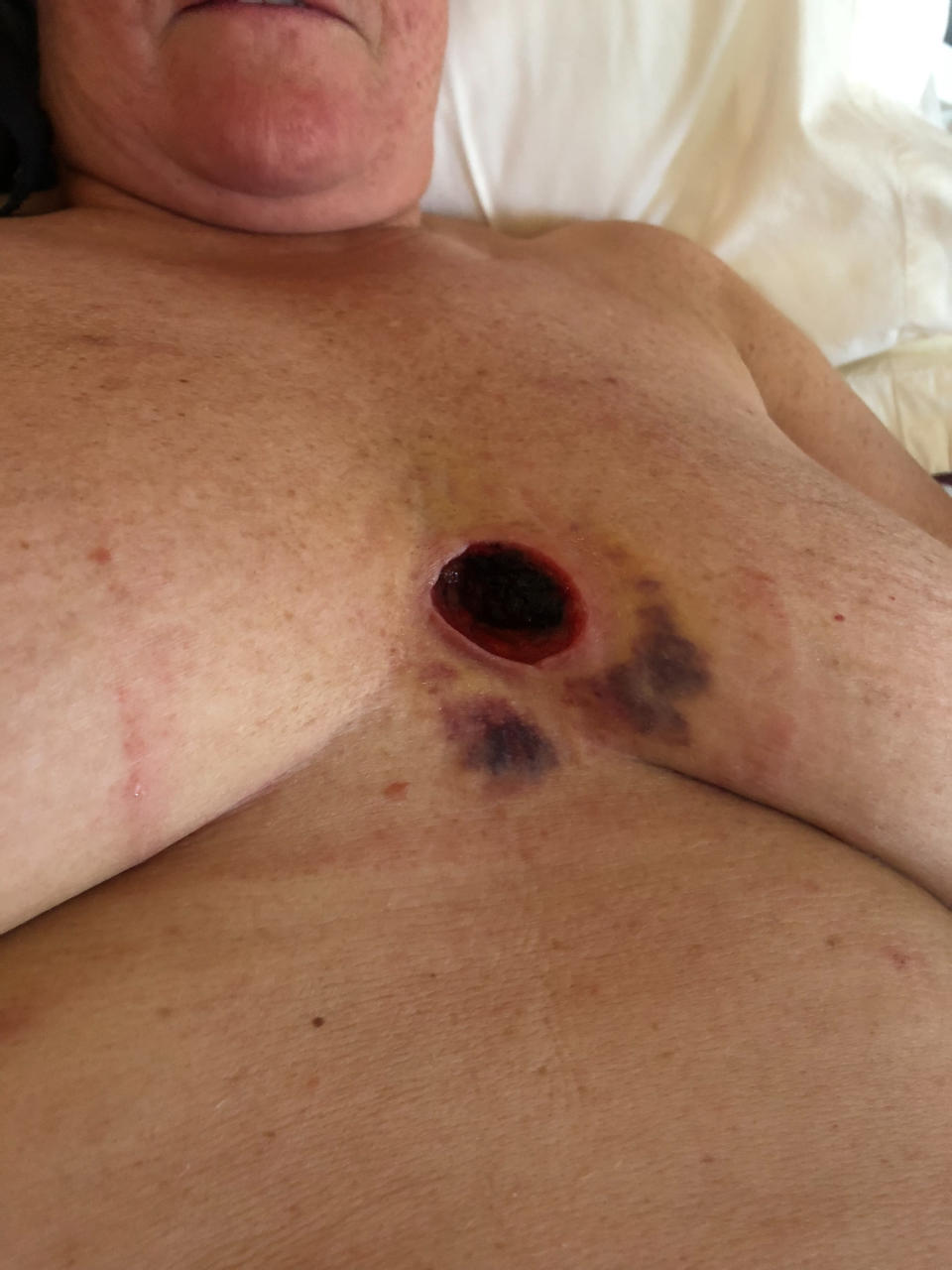 Lynne McConnell's chest after surgery. [Photo: SWNS]