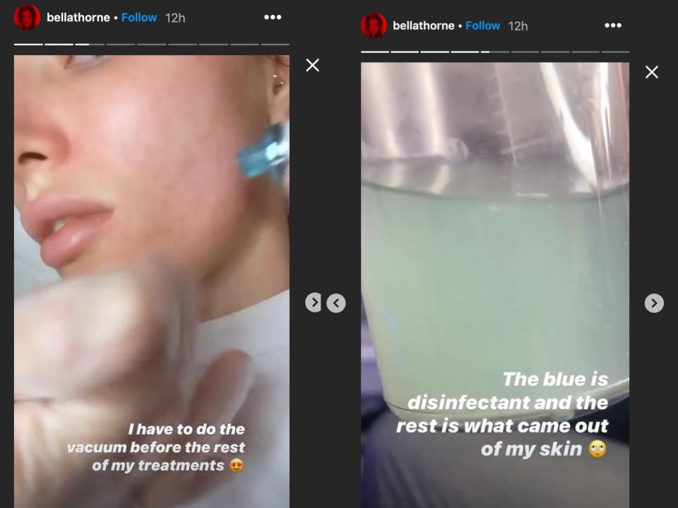 Bella Thorne Acne Treatment