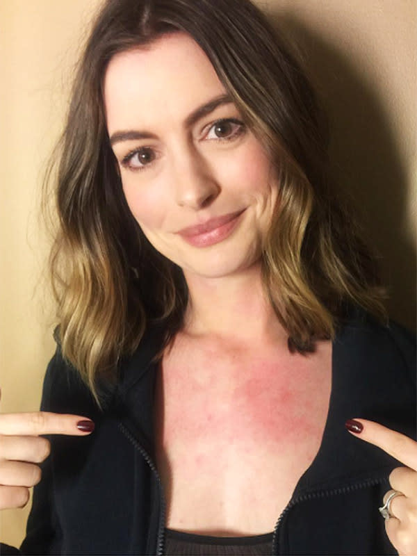 Anne Hathaway Hives The Ellen Show