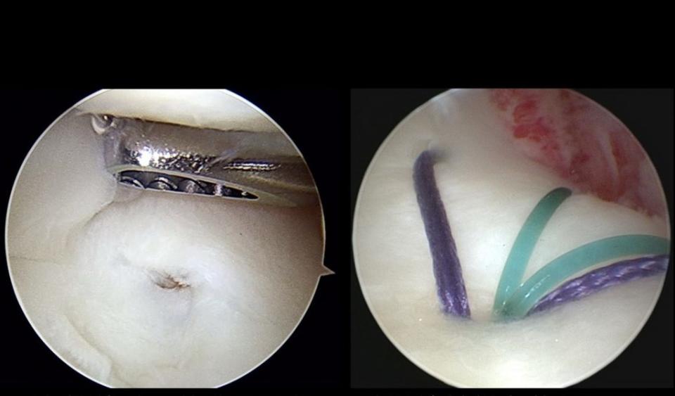 從腕關節鏡可看到患者ＴＦＣＣ有破損。（記者陳金龍攝）
