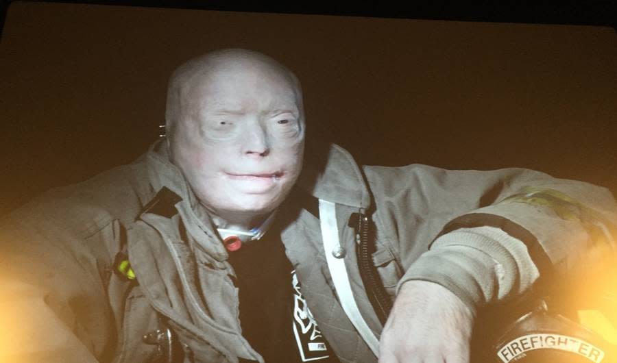 This Firefighter Just Received the Most Extensive Face Transplant in History