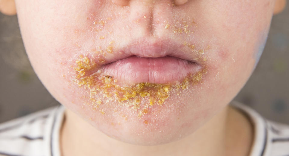 A boy with Impetigo, a skin infection that causes sores and blisters. 