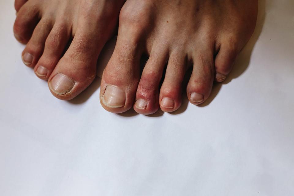 <span class="caption">Los dedos de los pies con covid se caracterizan por lesiones cutáneas rojas, hinchadas o con ampollas.</span> <span class="attribution"><a class="link " href="https://www.shutterstock.com/image-photo/covid-toes-another-symptom-coronavirus-infection-1712862949" rel="nofollow noopener" target="_blank" data-ylk="slk:Ternavskaia Olga Alibec/Shutterstock;elm:context_link;itc:0;sec:content-canvas">Ternavskaia Olga Alibec/Shutterstock</a></span>