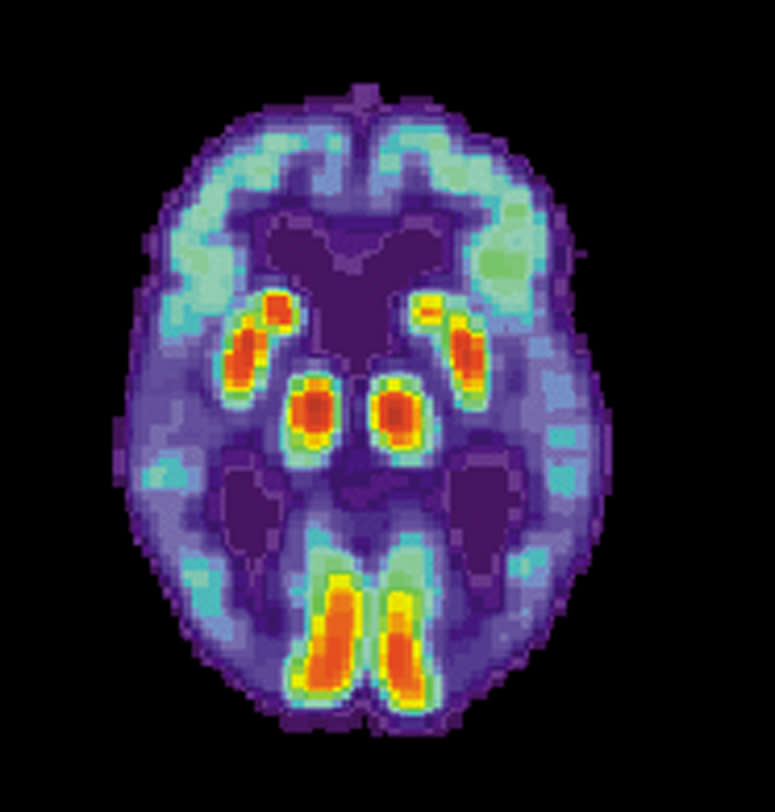 PET scan of the brain of a person with Alzheimer's disease showing a loss of function in the temporal lobe. (Photo/WikiCommons)