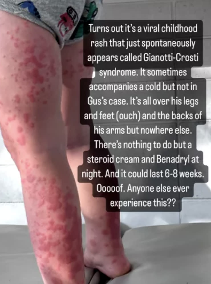 A closeup of a red rash all over a child's legs