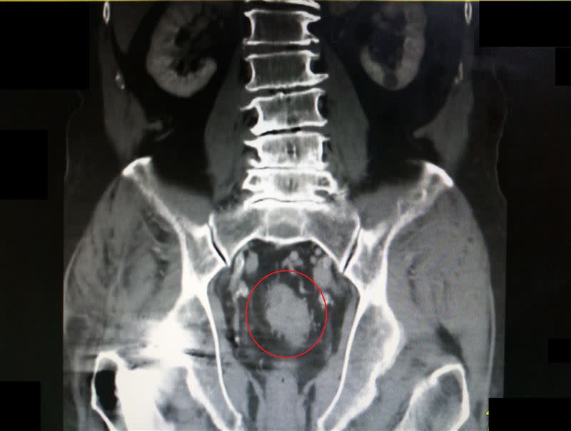 李先生的排便習慣改變，檢查竟發現大腸癌第三期（紅圈處）（圖／大千綜合醫院提供）