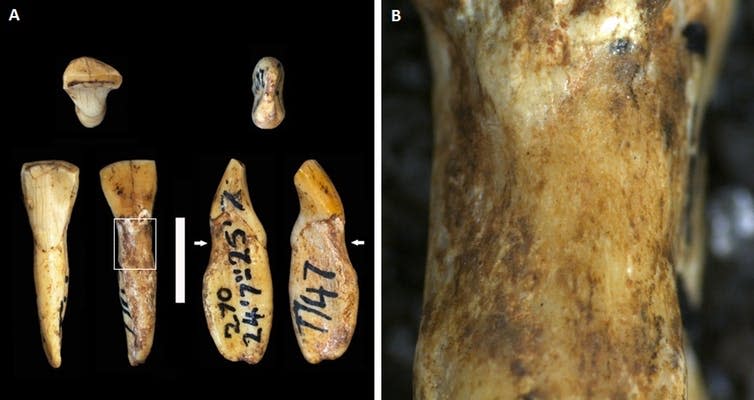 <span class="caption"><em>Australopithecus africanus</em> teeth with lesions.</span> <span class="attribution"><span class="source">Ian Towle</span>, <span class="license">Author provided</span></span>