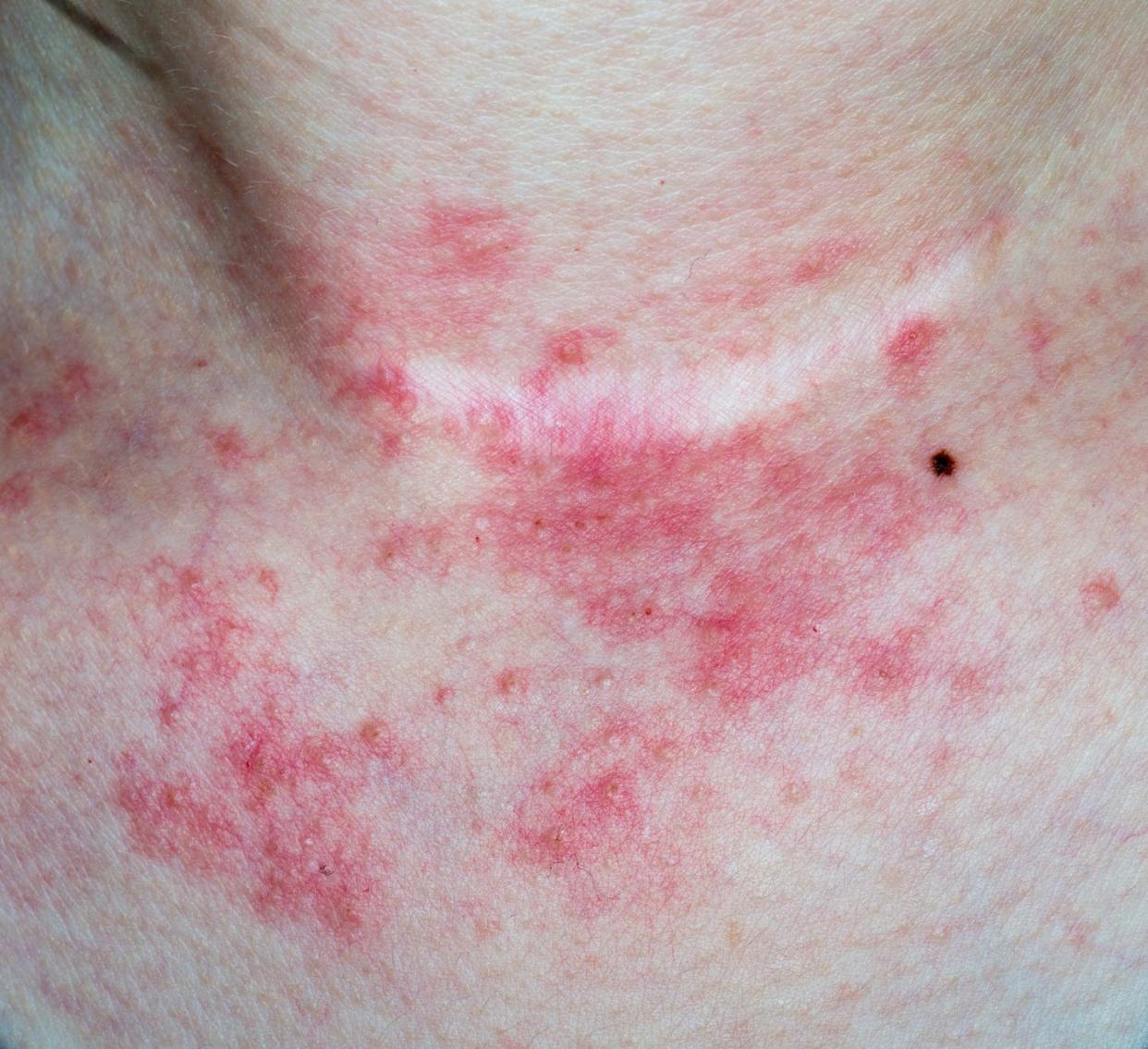 eczema skin on neck