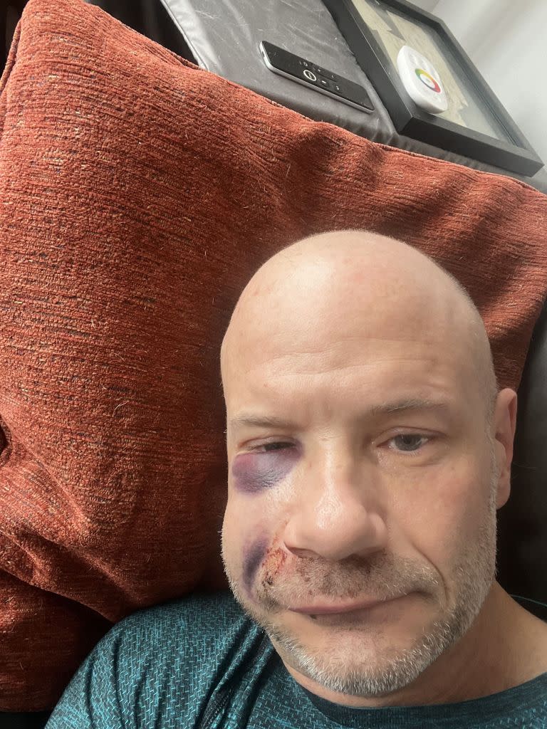 Zollinger didn’t leave his apartment for three days following the accident because he was self-conscious of his swollen face. Kennedy News & Media