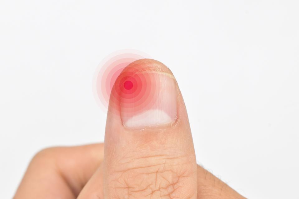 甲溝炎痛起來令人坐立難安，指甲剪太短者需要多多留意。示意圖來源：Getty Images