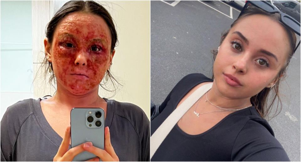 Guaca says cutting nuts, dairy and gluten from her diet has helped her skin. (Caters)