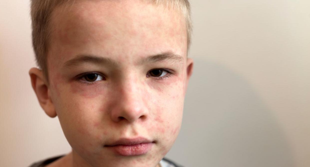 Child with measles. (Getty Images)