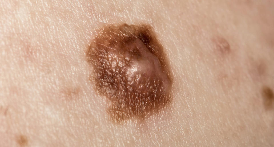 Macro image of a suspicious mole seen close up. The mole was later removed in surgery and found to be pre cancerous.