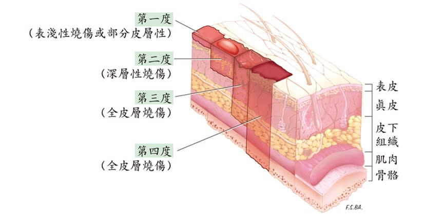 被誤傷的女顧客右腿二級燒燙傷，相當於深層性燒傷。（圖／翻攝自陽光社會福利基金會）