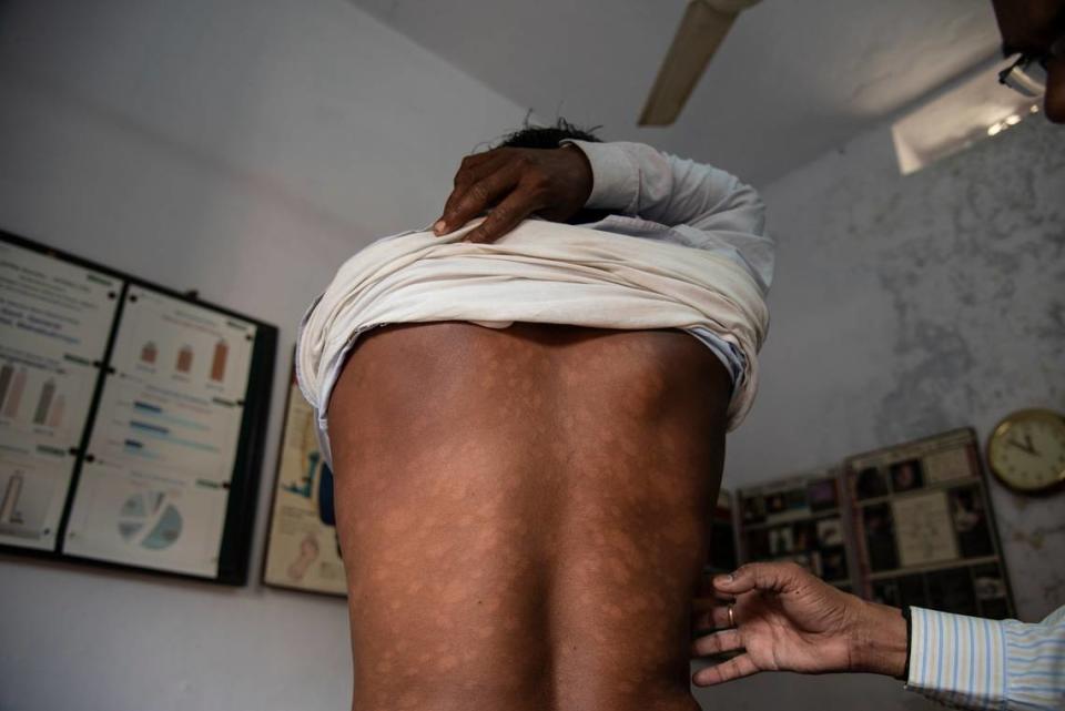 Bathika Narsimha muestra marcas de lepra en su espalda en el Centro de la Sociedad Lepra en Mahabubnagar, India, el 19 de febrero de 2019. Trabajadores sanitarios pensaron que habían vencido a la enfermedad en 2005. Pero siguió viva, envuelta en el estigma y el misterio médico.