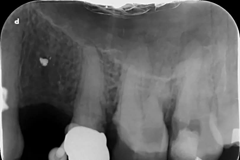 An X-ray showing the damage -Credit:Ms Georgia Creary / Dental Law Partnership