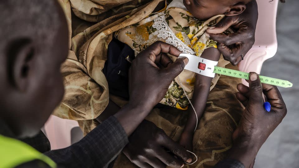 A health worker measures the circumference of a Sudanese child's arm at the clinic of a transit center for refugees in Renk, South Sudan, on February 13, 2024. - Luis Tato/AFP/Getty Images