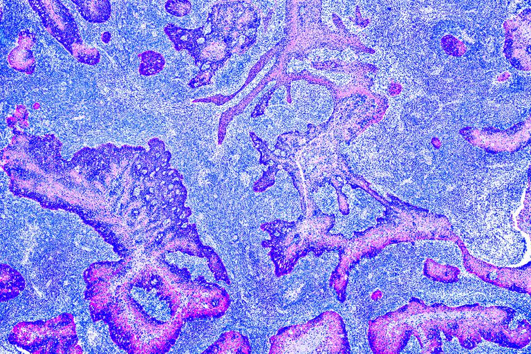 Células cancerosas manchadas con tintes específicos de diferentes proteínas para su estudio